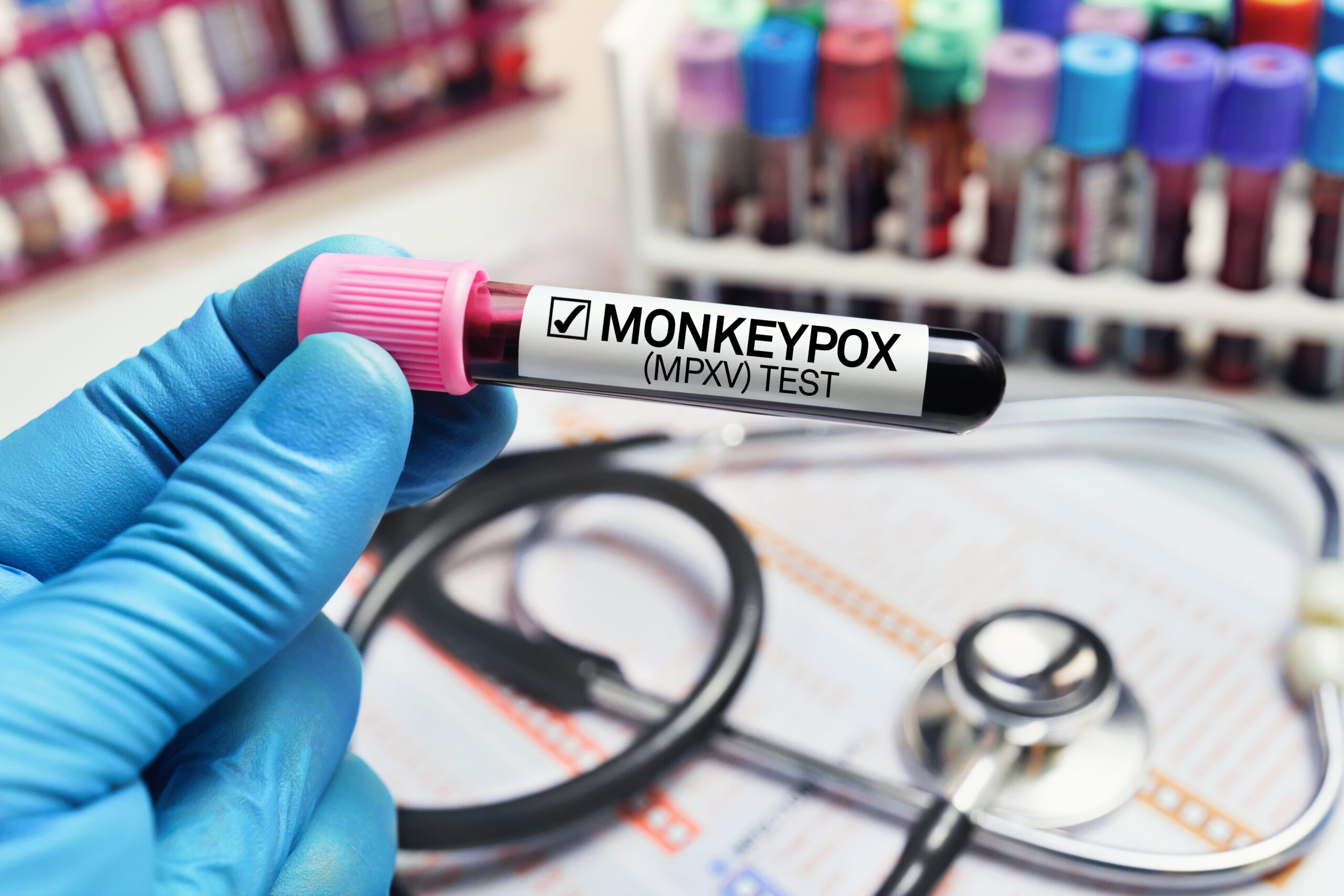 Don’t downplay monkeypox — here’s what you should know